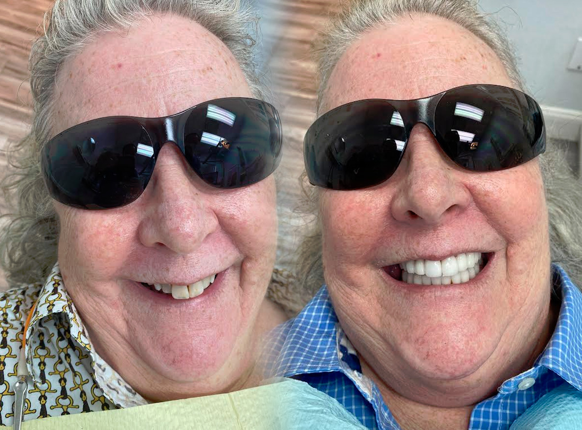 Teeth Whitening in Tappan Dental Crowns Tappan Old Tappan Cosmetic