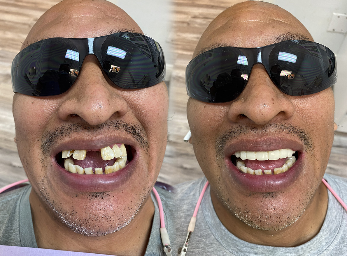 Teeth Whitening in Tappan Dental Crowns Tappan Old Tappan Cosmetic