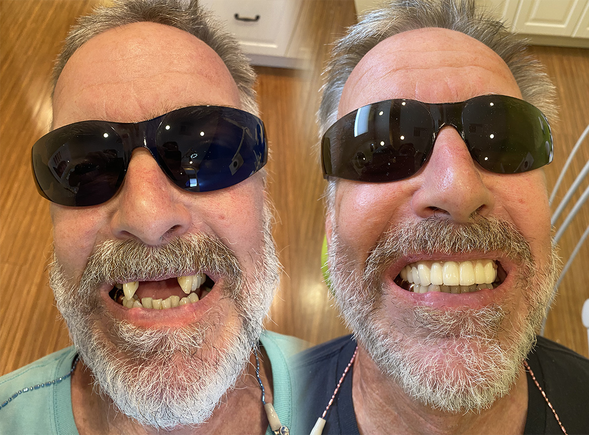 Teeth Whitening in Tappan Dental Crowns Tappan Old Tappan Cosmetic