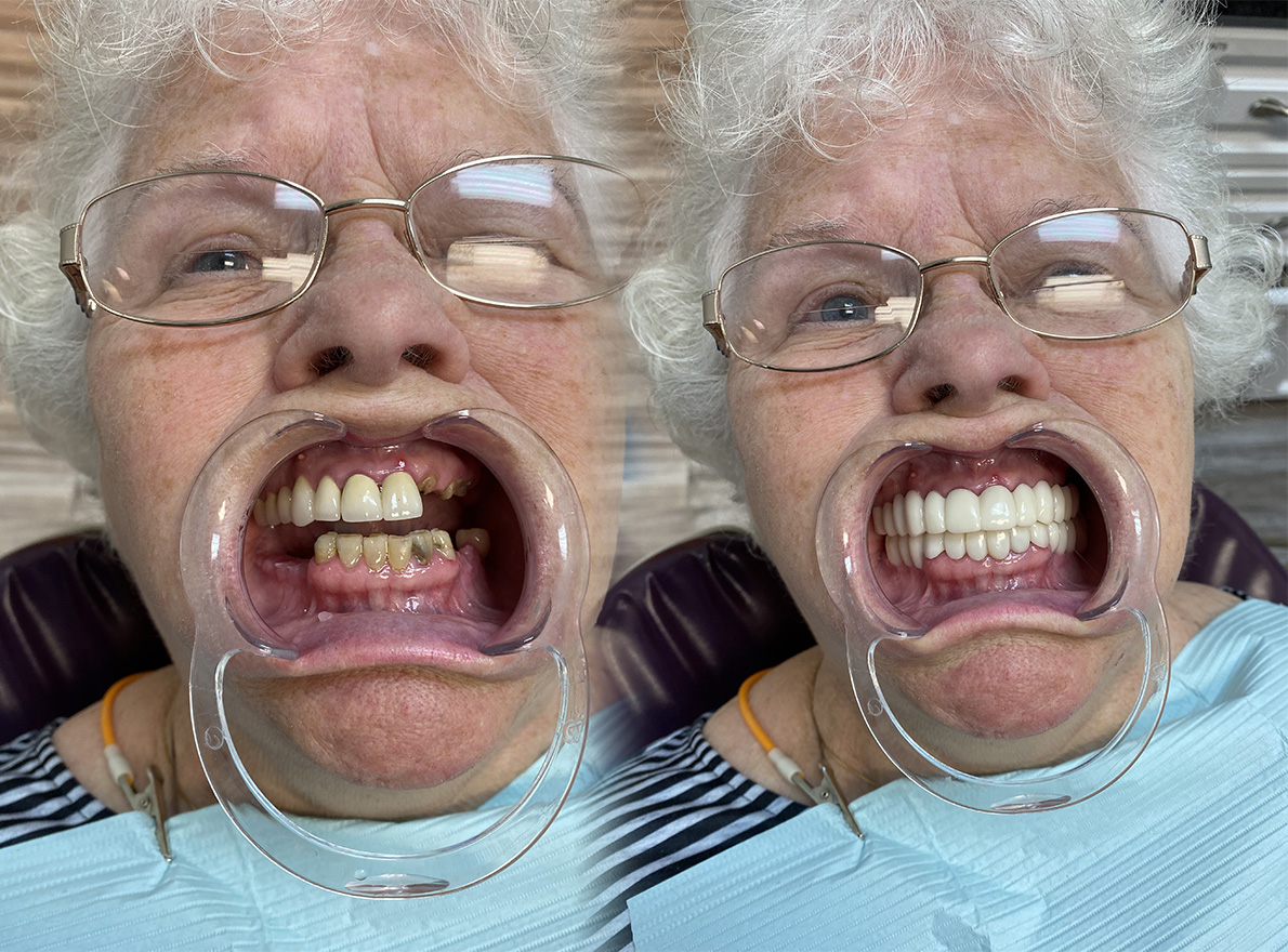 Teeth Whitening in Tappan Dental Crowns Tappan Old Tappan Cosmetic