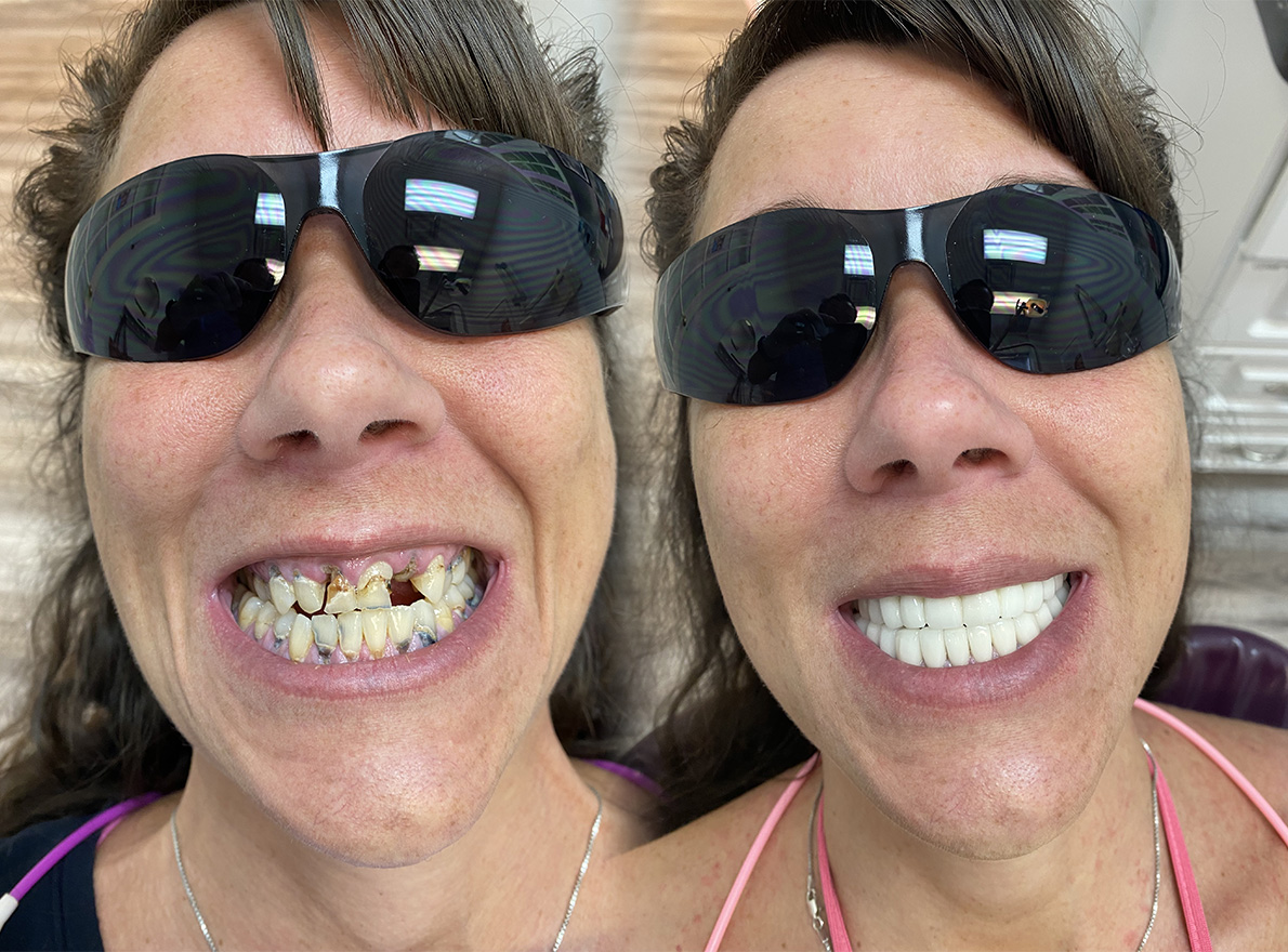 Teeth Whitening in Tappan Dental Crowns Tappan Old Tappan Cosmetic