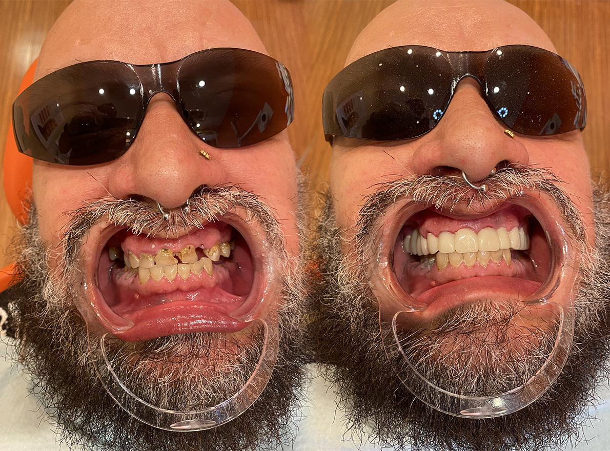 Teeth Whitening in Tappan Dental Crowns Tappan Old Tappan Cosmetic